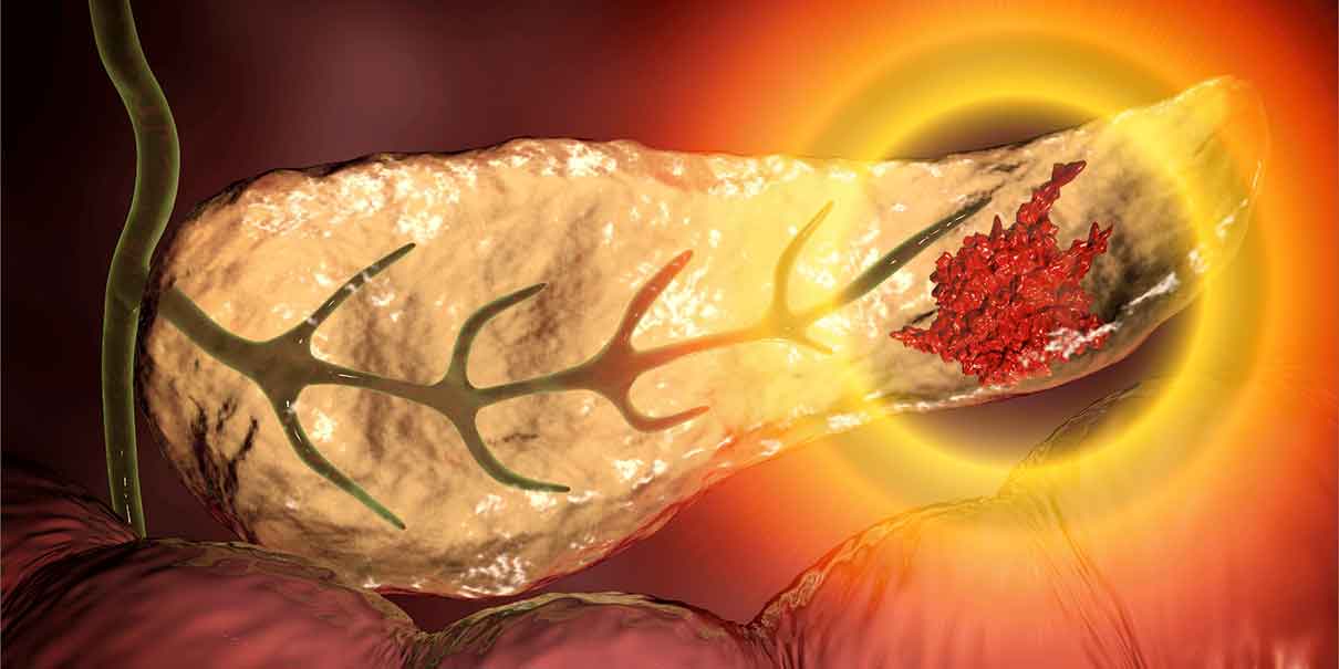 Cáncer de páncreas