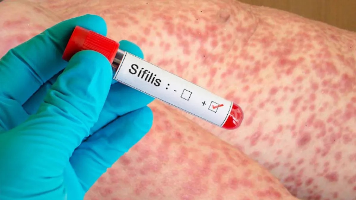 sífilis
