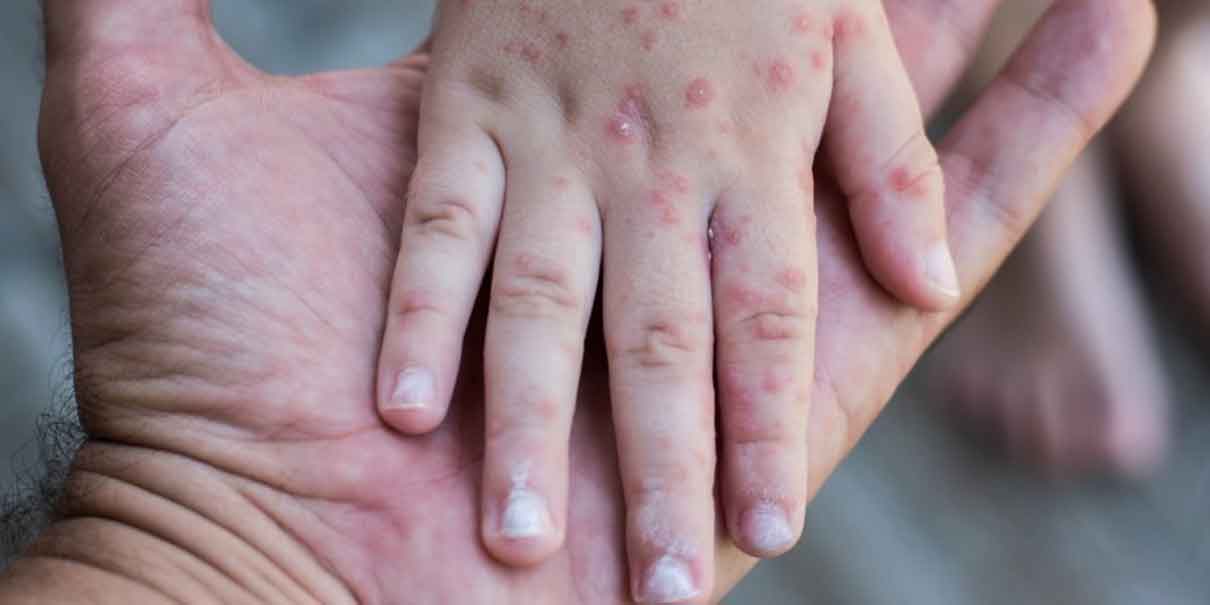 Virus Cosackie