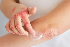 Dermatitis atópica: impacto en la vida diaria y nuevos tratamientos