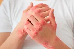 Sífilis: síntomas, cómo prevenirla y qué hacer ante una infección