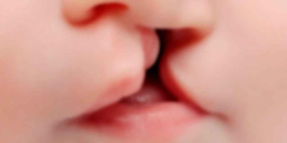 Uno de cada 700 niños nace con labio y paladar hendido a nivel mundial: académico Upaep