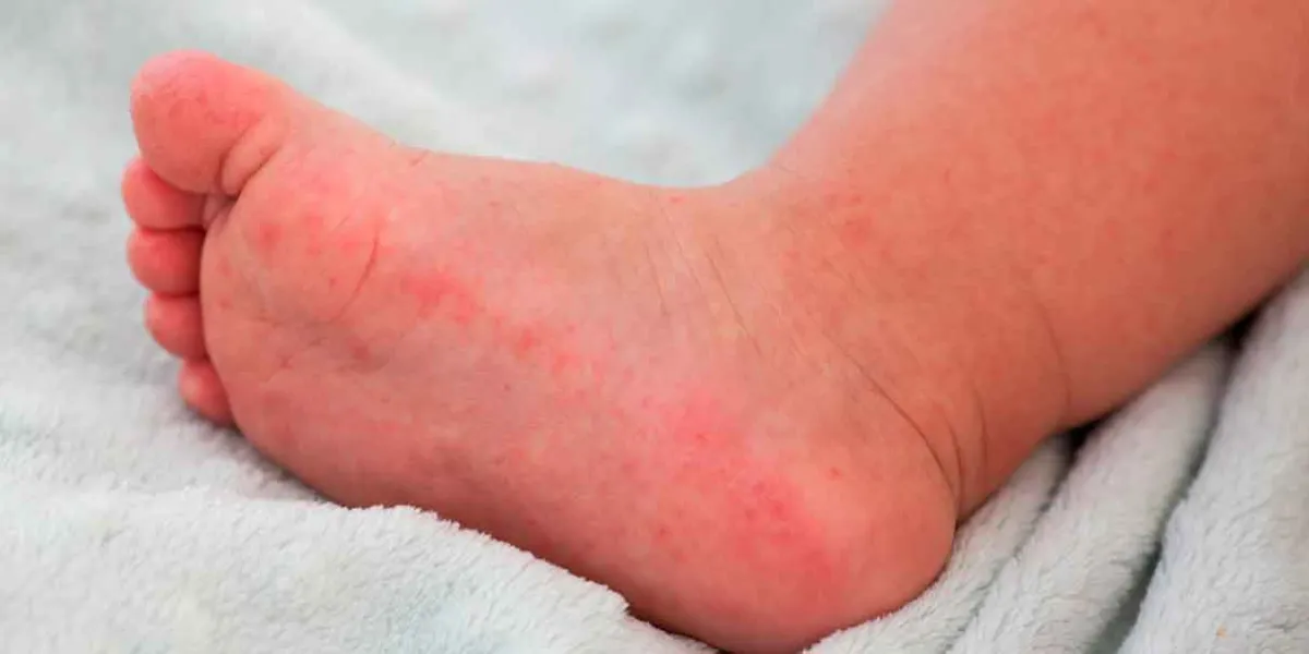 Texmelucan: 14 niños contagiados con Coxsackie; medidas preventivas en marcha