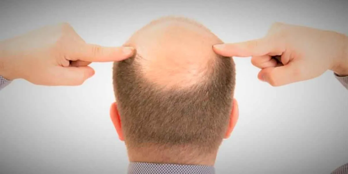 La caída del cabello en hombres: 5 claves para frenar la alopecia y recuperar tu confianza