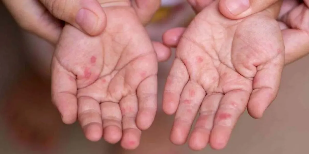 Preescolar en Izúcar suspende clases tras brote de virus coxsackie