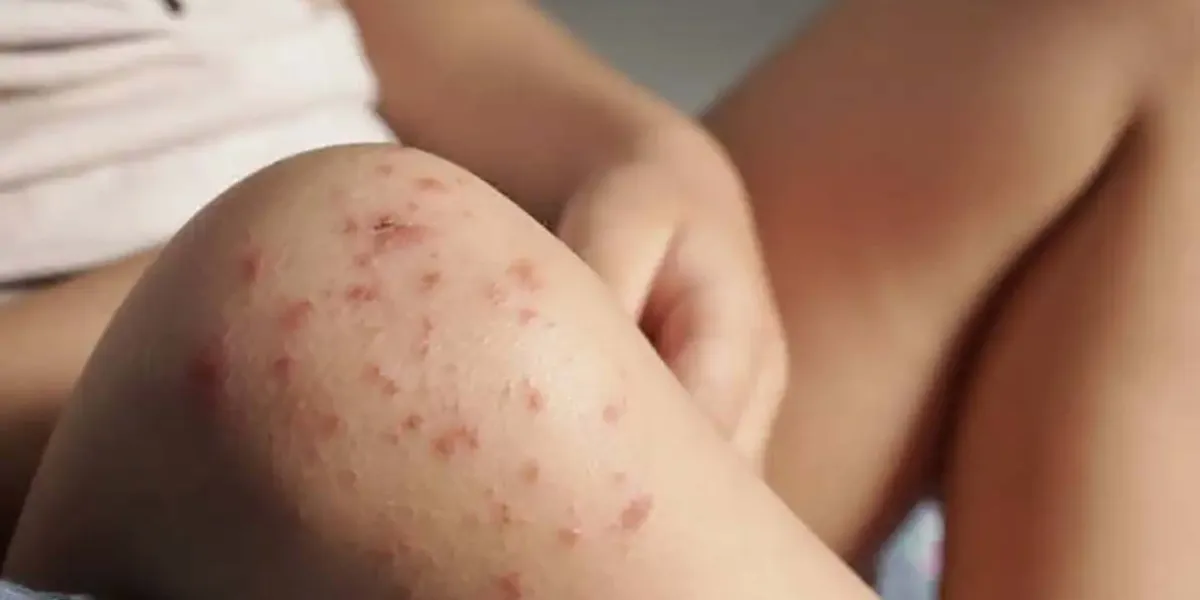 SEP Puebla confirma contagios de virus Coxsackie en escuelas de Chalchicomula y Tlachichuca