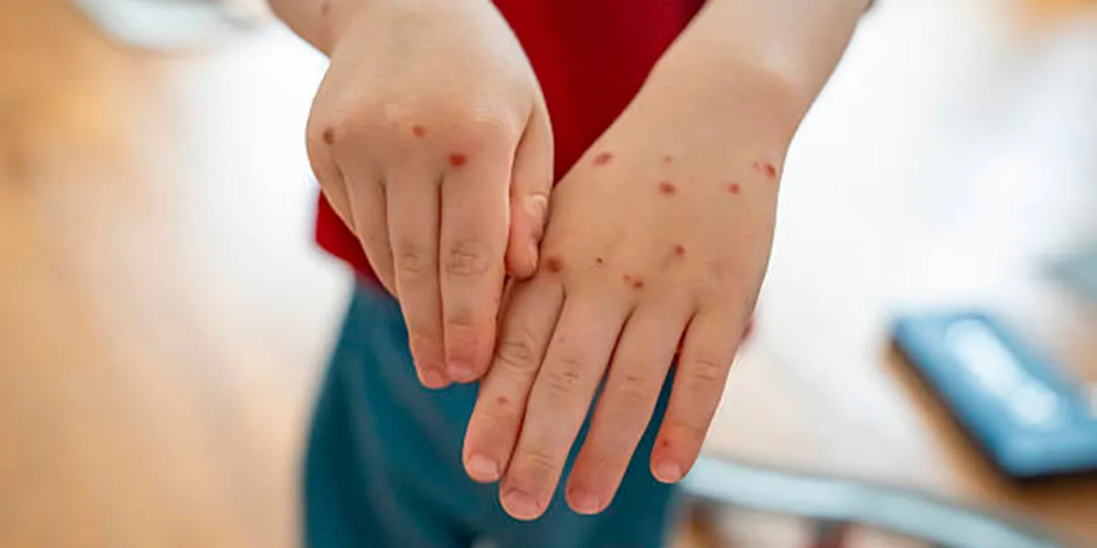 Brote de virus Coxsackie alarma a padres en Centro Escolar de Ciudad Serdán