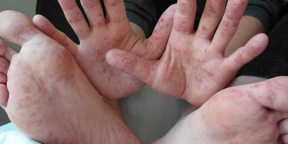Chiautzingo alerta por posibles casos del virus Coxsackie: autoridades piden vigilancia en escuelas