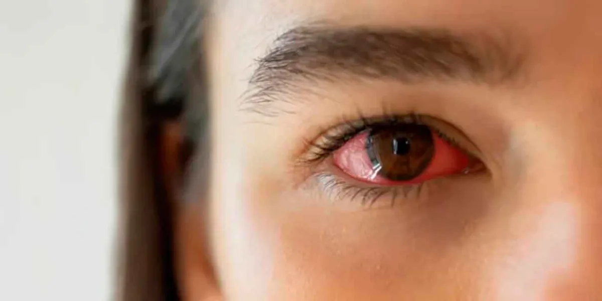 Campaña busca visibilizar el ojo seco en México; hasta 30 millones presentan síntomas