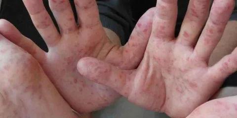 Se propaga el Virus de Coxsackie en escuelas poblanas; analizan uso de cubrebocas