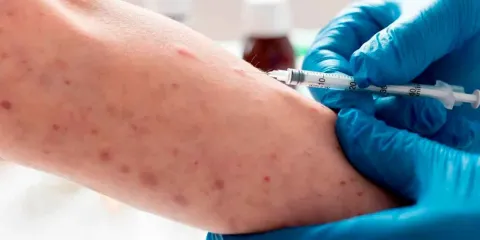 Aumentan a 53 los casos de sarampión en Puebla