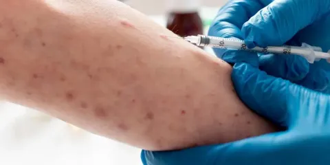 Casos de sarampión en Puebla van a la baja: más de 1.1 millones vacunados y fuerte inversión en salud