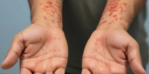 Sigue en aumento el contagio de Sarampión en Puebla, hay 145 casos