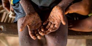 Suecia reporta primer caso de variante peligrosa de mpox fuera de África